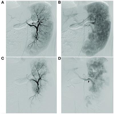 Super-Selective Partial Splenic Embolization for Hereditary Spherocytosis in Children: A Single-Center Retrospective Study